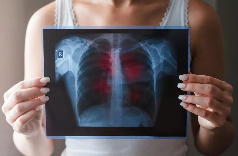 Новий стандарт допомоги МОЗ за туберкульозу: акцент на профілактиці та коротких схемах лікування